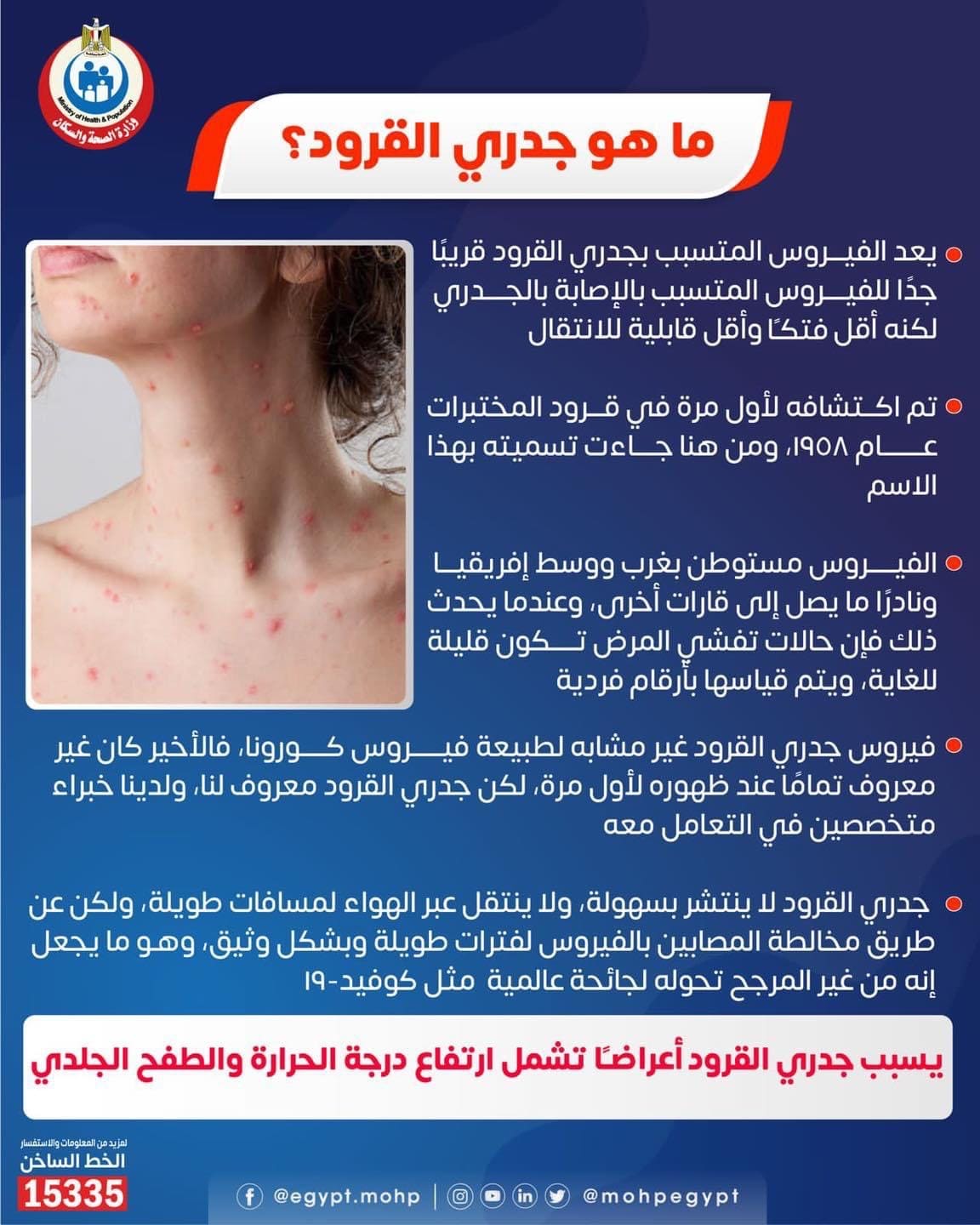 جدري القرود